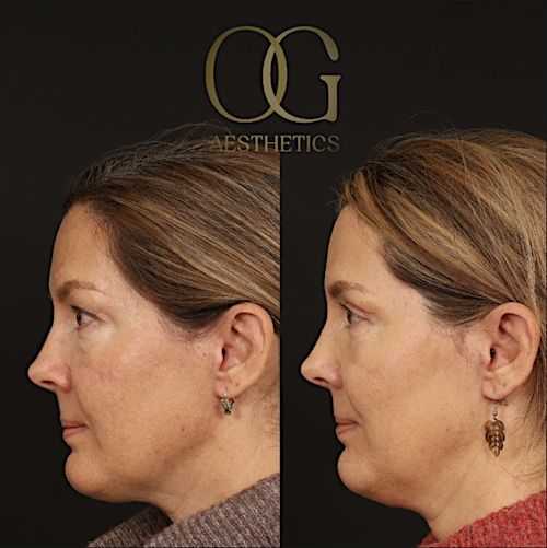 Blepharoplasty Before & After Gallery - Patient 592690 - Image 6