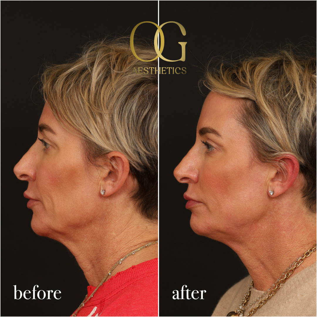 Blepharoplasty Before & After Gallery - Patient 306285 - Image 5