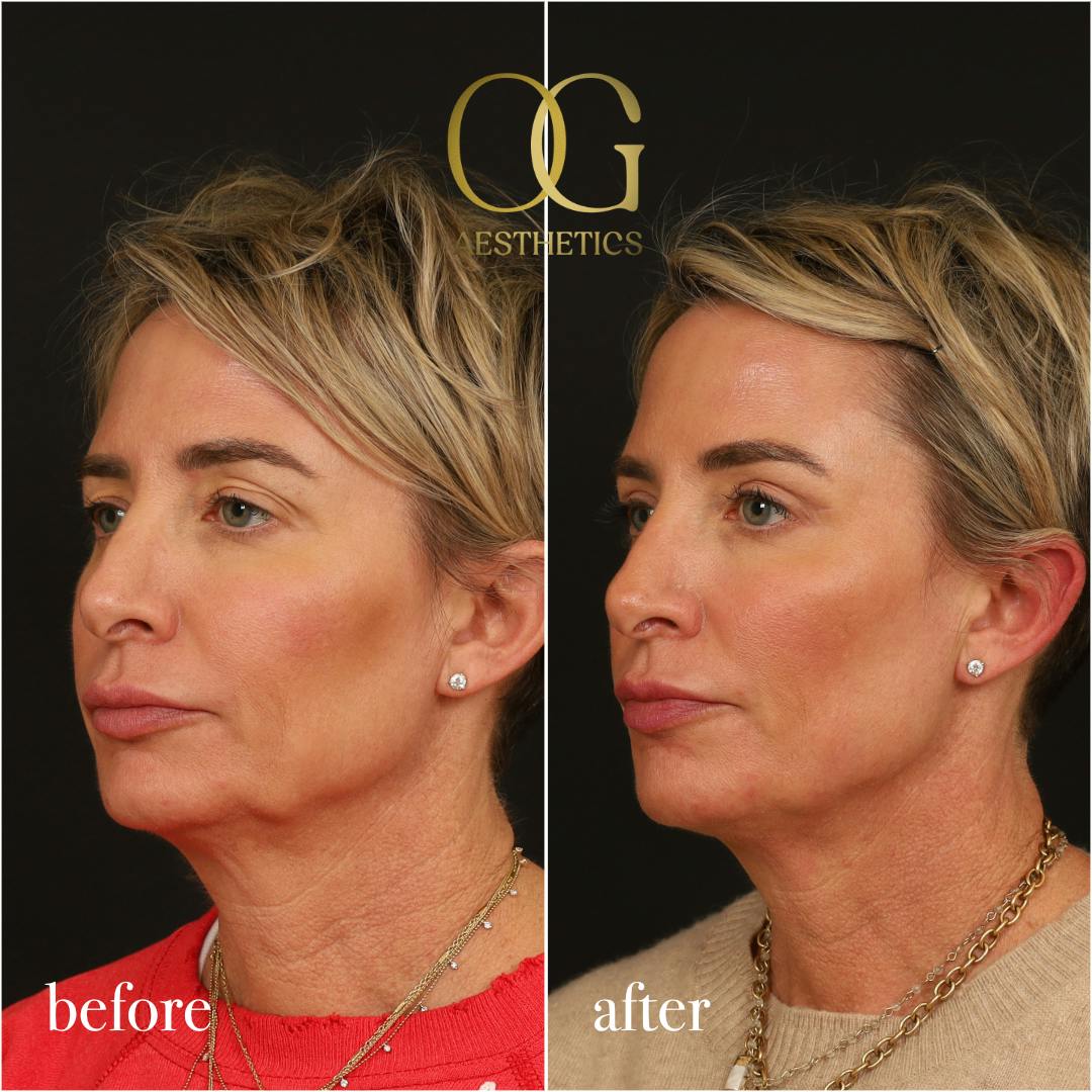 Blepharoplasty Before & After Gallery - Patient 306285 - Image 6