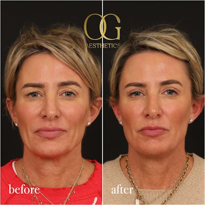 Blepharoplasty Before & After Gallery - Patient 306285 - Image 1
