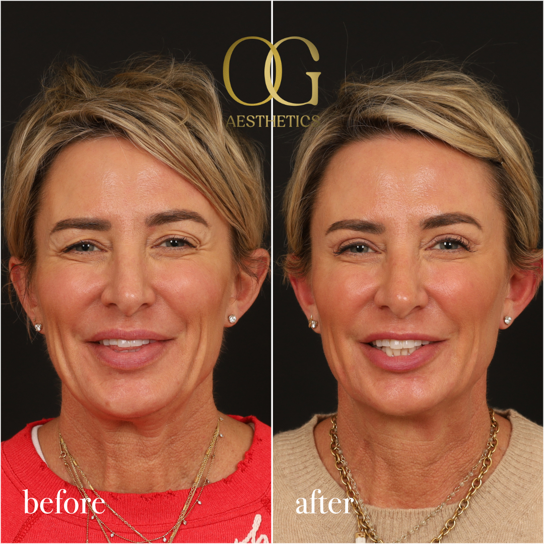 Blepharoplasty Before & After Gallery - Patient 306285 - Image 2