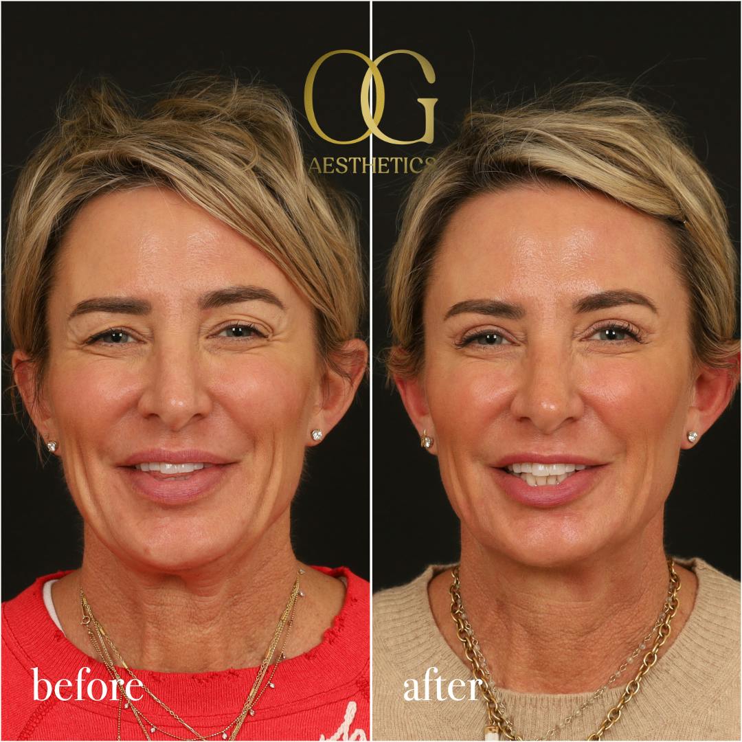 Blepharoplasty Before & After Gallery - Patient 306285 - Image 2