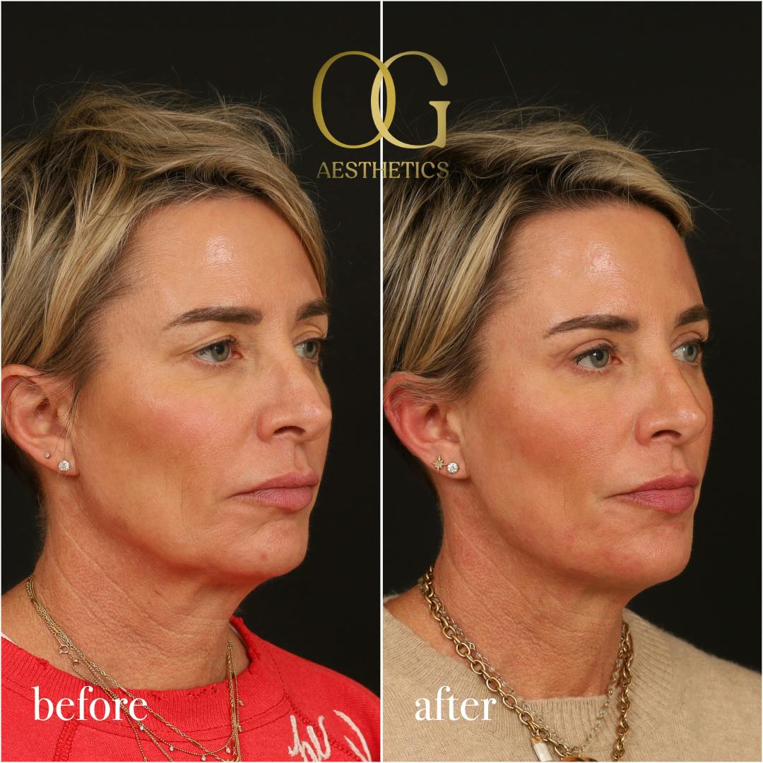 Blepharoplasty Before & After Gallery - Patient 306285 - Image 3