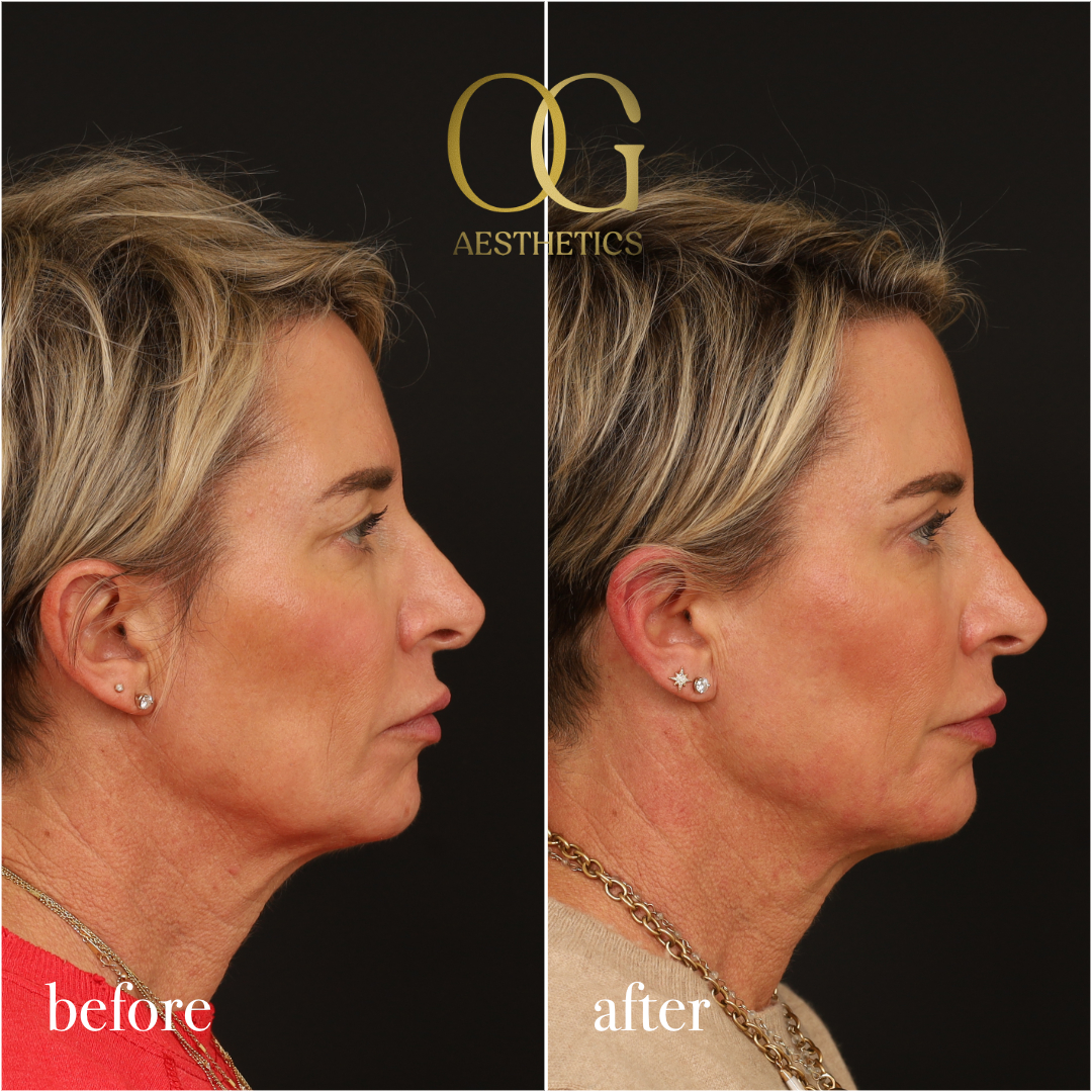 Blepharoplasty Before & After Gallery - Patient 306285 - Image 4