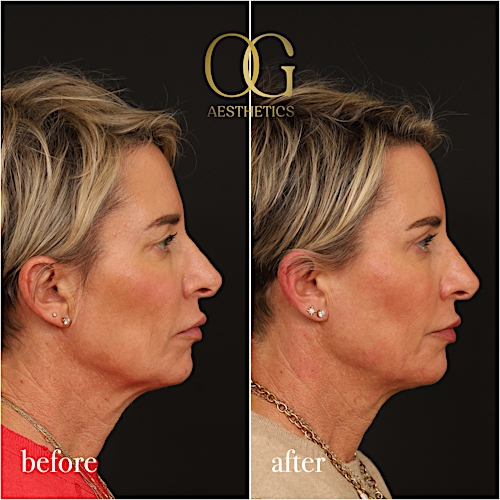 Blepharoplasty Before & After Gallery - Patient 306285 - Image 4