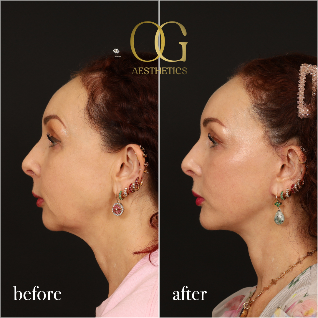 Chin Augmentation Before & After Gallery - Patient 177463 - Image 4
