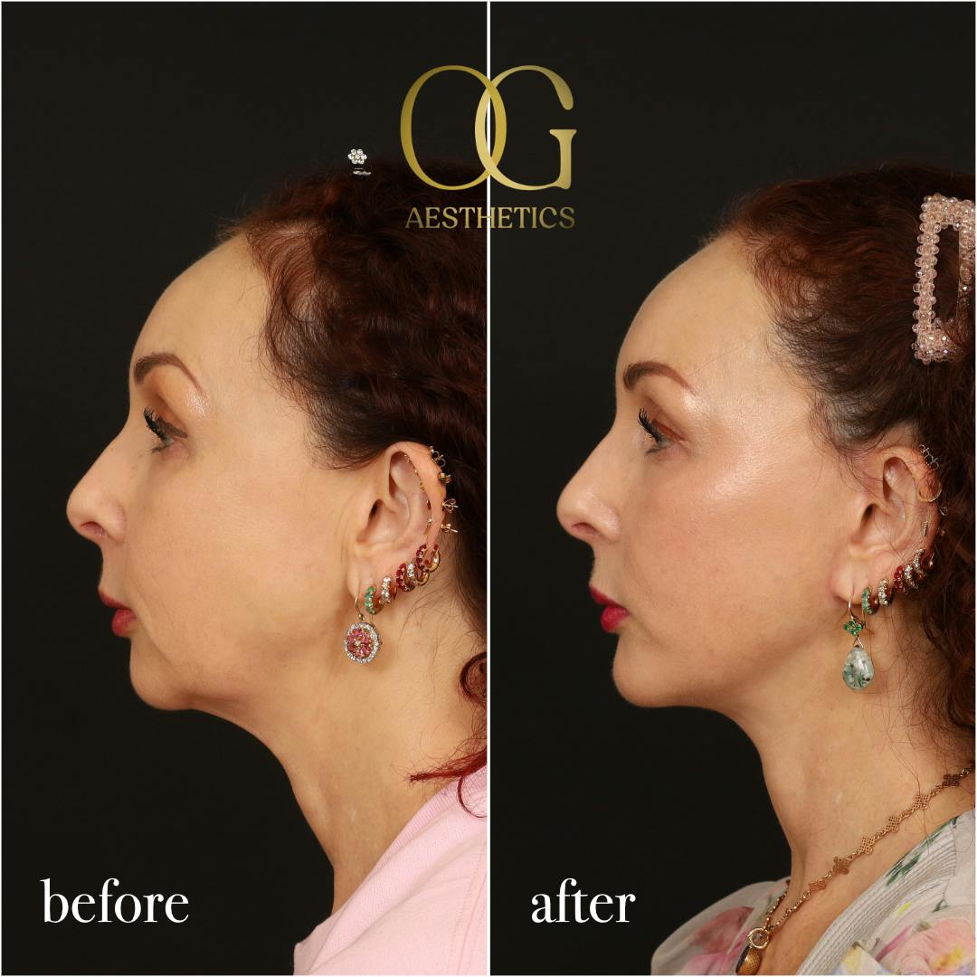Facelift Before & After Gallery - Patient 180113 - Image 4