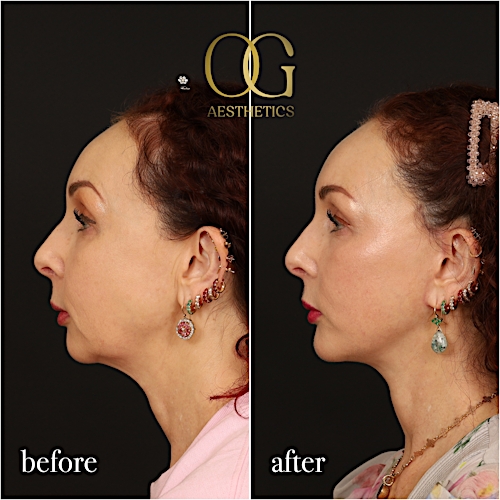 Facelift Before & After Gallery - Patient 180113 - Image 4