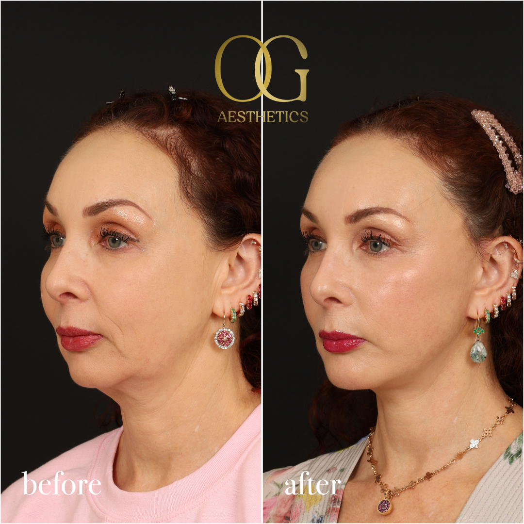 Chin Augmentation Before & After Gallery - Patient 177463 - Image 5