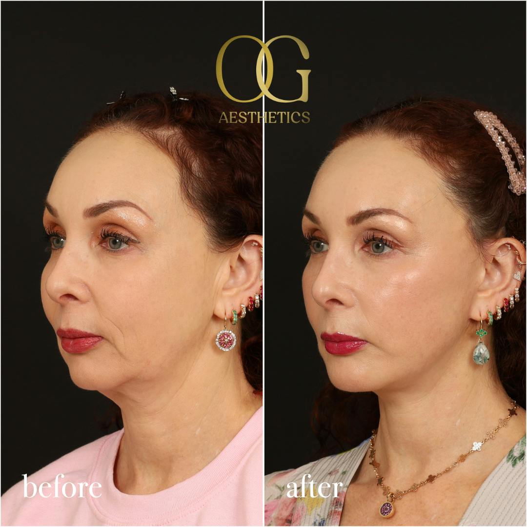 Facelift Before & After Gallery - Patient 180113 - Image 5