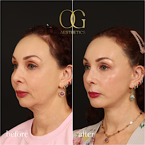 Facelift Before & After Gallery - Patient 180113 - Image 5