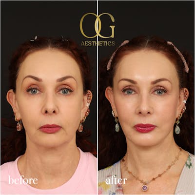 Facelift Before & After Gallery - Patient 180113 - Image 1