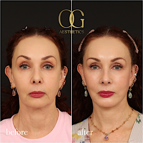 Facelift Before & After Gallery - Patient 180113 - Image 1