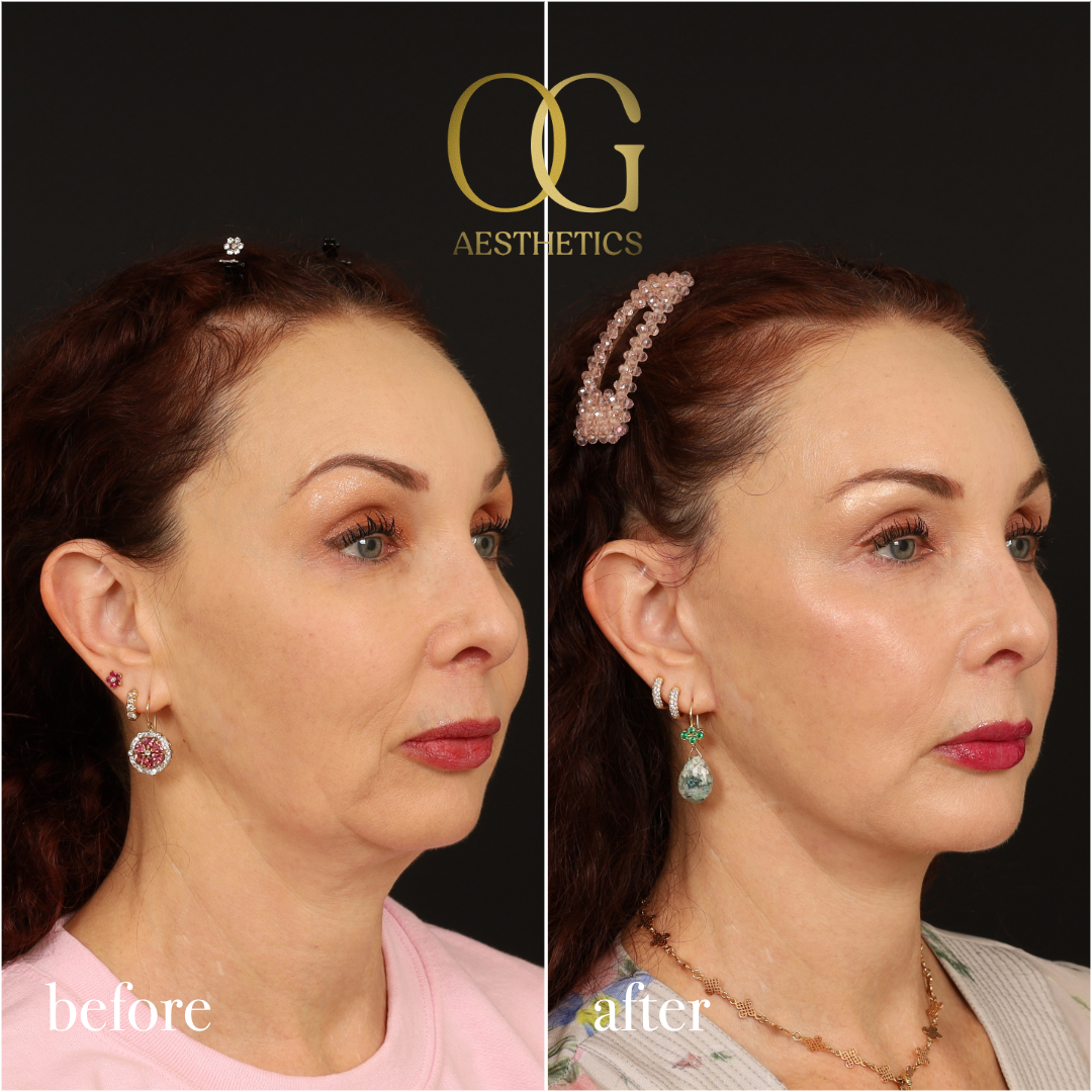 Chin Augmentation Before & After Gallery - Patient 177463 - Image 2