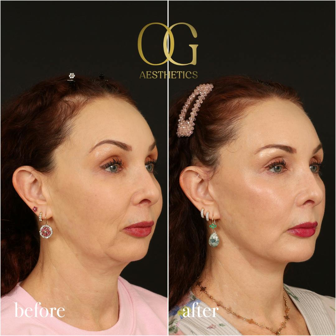 Facelift Before & After Gallery - Patient 180113 - Image 2
