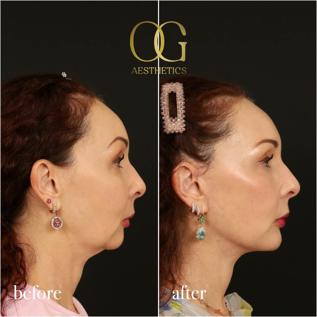 Facelift Before & After Gallery - Patient 180113 - Image 3