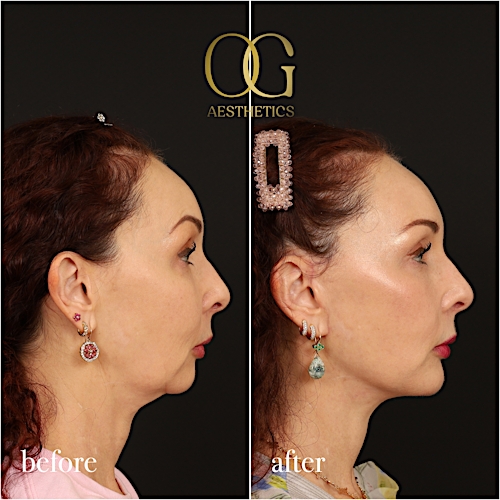 Facelift Before & After Gallery - Patient 180113 - Image 3