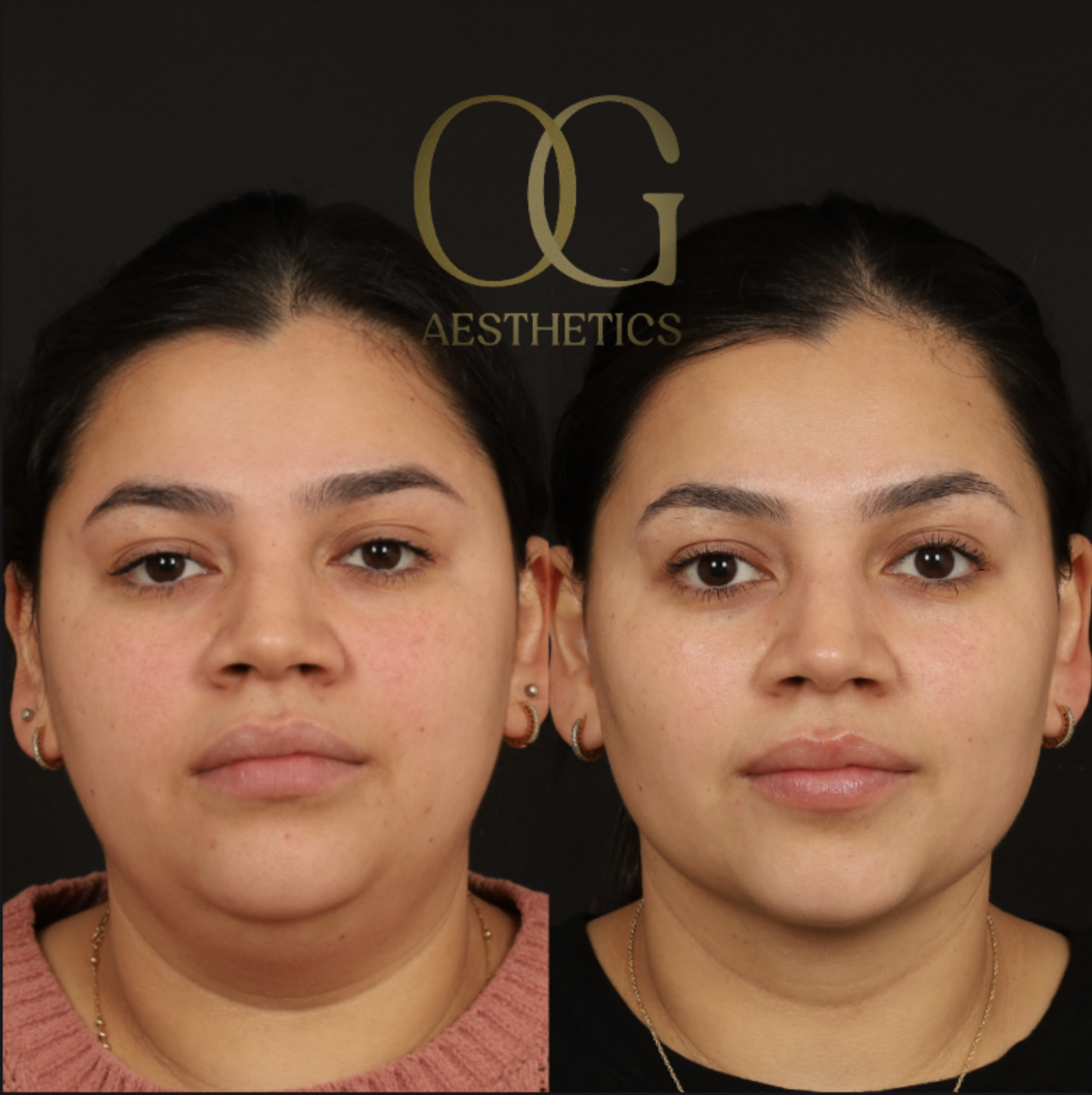 Minimally Invasive Facial Contouring Before & After Gallery - Patient 982721 - Image 1