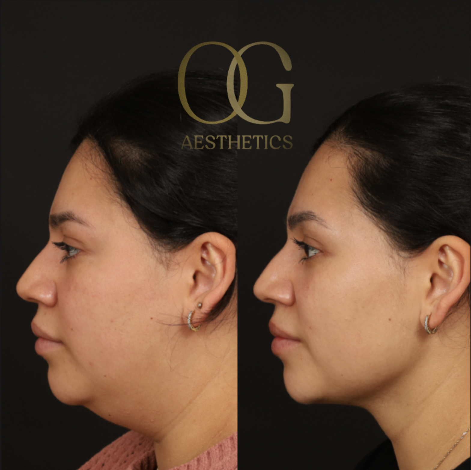 Minimally Invasive Facial Contouring Before & After Gallery - Patient 982721 - Image 3