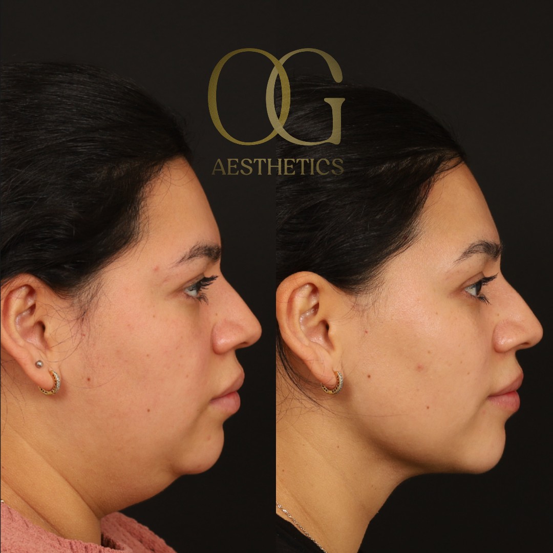 Minimally Invasive Facial Contouring Before & After Gallery - Patient 982721 - Image 5