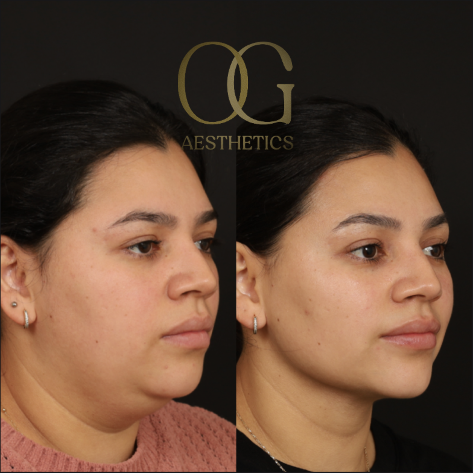 Minimally Invasive Facial Contouring Before & After Gallery - Patient 982721 - Image 4