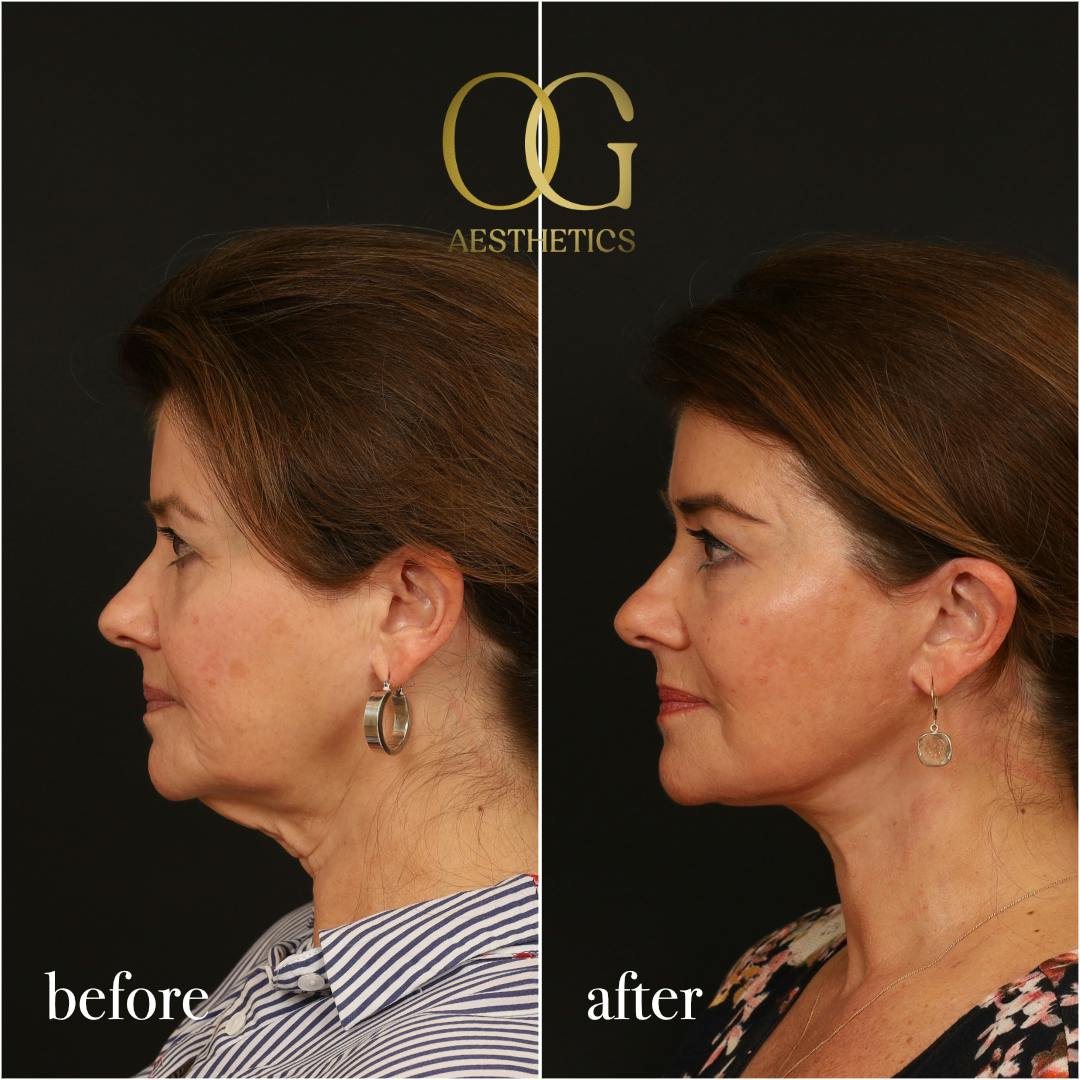 Facelift Before & After Gallery - Patient 616249 - Image 6