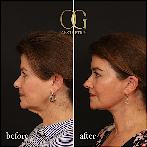 Facelift Before & After Gallery - Patient 616249 - Image 6