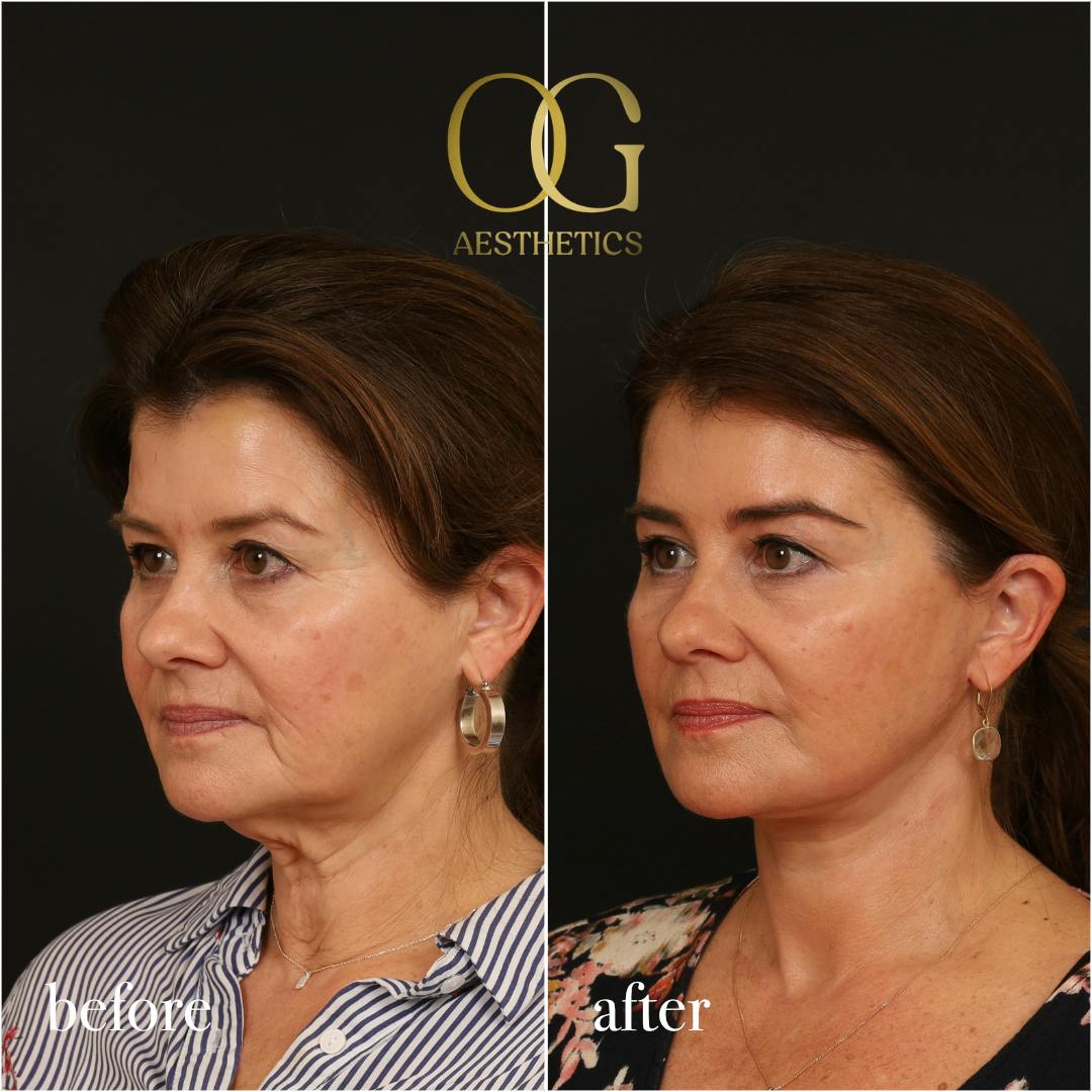 Facelift Before & After Gallery - Patient 616249 - Image 5