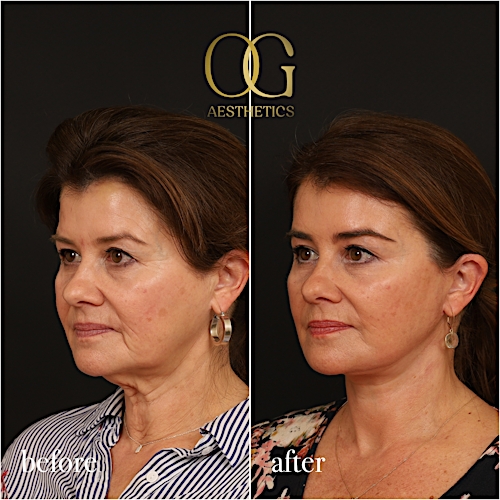 Facelift Before & After Gallery - Patient 616249 - Image 5
