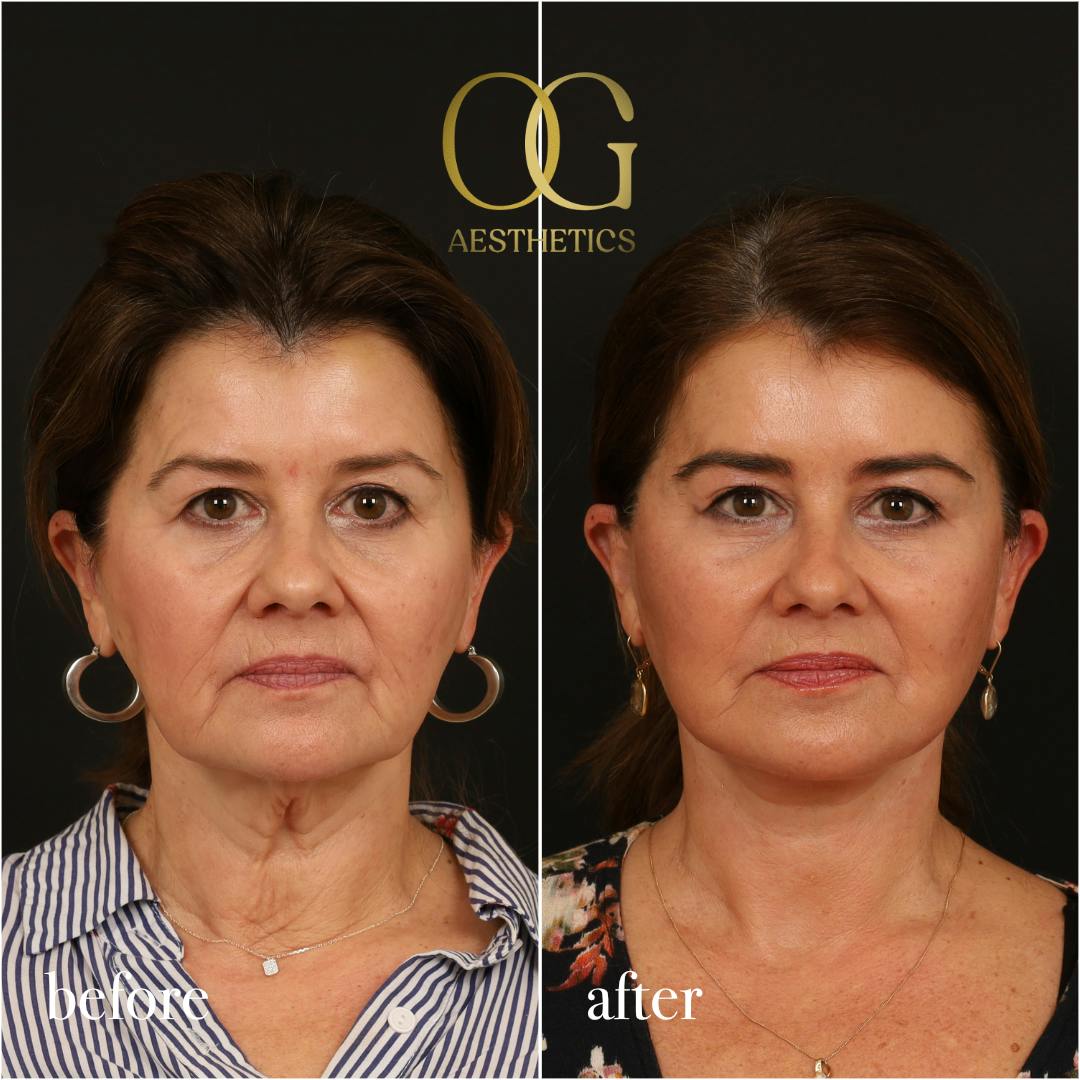 Facelift Before & After Gallery - Patient 616249 - Image 1
