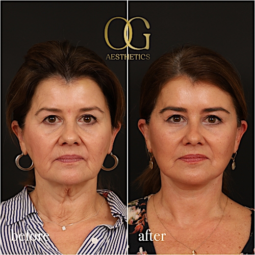 Facelift Before & After Gallery - Patient 616249 - Image 1