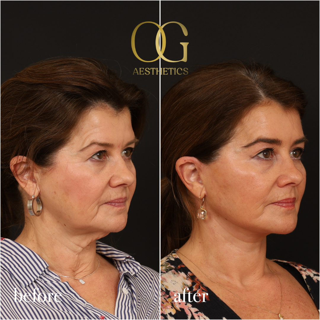 Neck Lift Before & After Gallery - Patient 289549 - Image 3