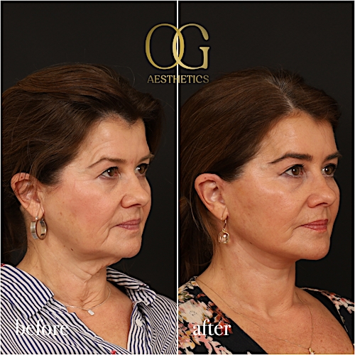 Facelift Before & After Gallery - Patient 616249 - Image 3