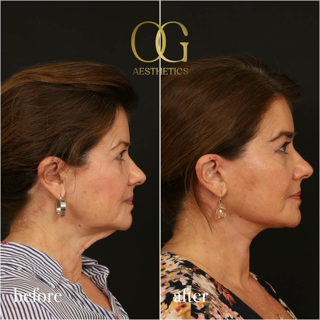 Facelift Before & After Gallery - Patient 616249 - Image 4