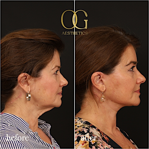 Facelift Before & After Gallery - Patient 616249 - Image 4