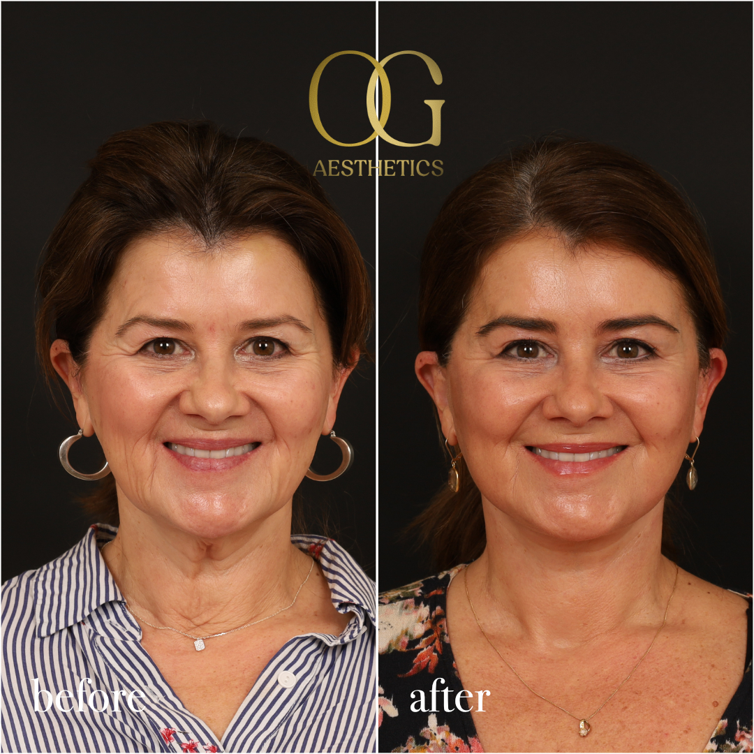 Neck Lift Before & After Gallery - Patient 289549 - Image 2