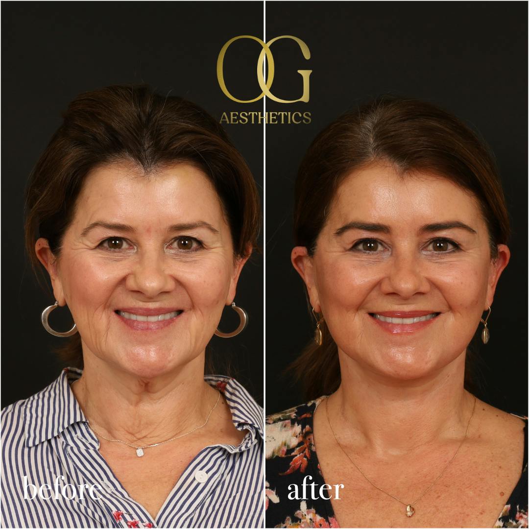 Facelift Before & After Gallery - Patient 616249 - Image 2