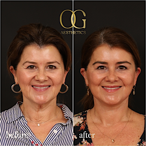 Facelift Before & After Gallery - Patient 616249 - Image 2
