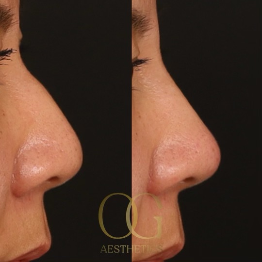 Non-Surgical Rhinoplasty Before & After Gallery - Patient 273494 - Image 1