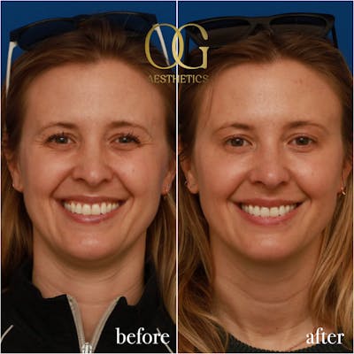 Forehead, Glabella (11's) & Crow's Feet Before & After Gallery - Patient 856529 - Image 1