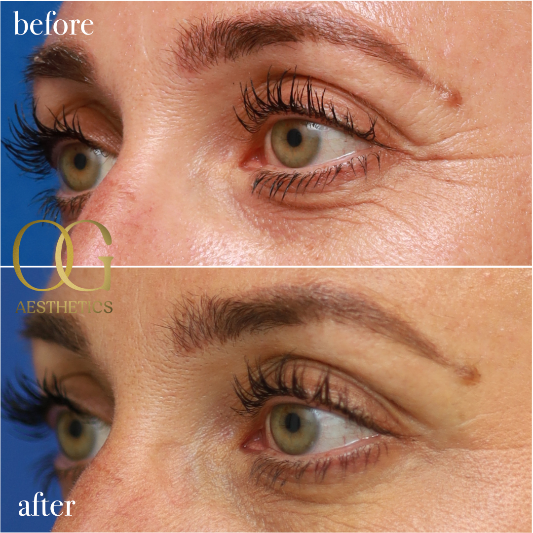 Forehead, Glabella (11's) & Crow's Feet Before & After Gallery - Patient 589952 - Image 1