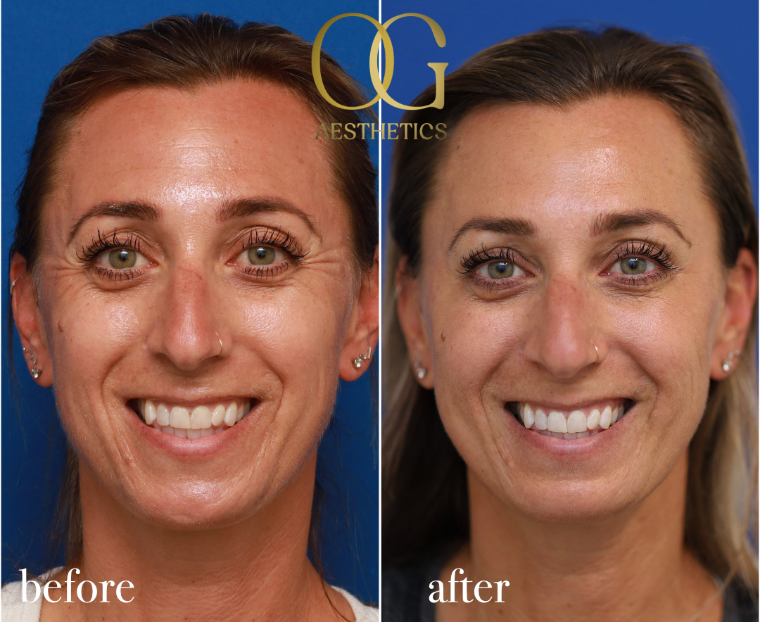 Forehead, Glabella (11's) & Crow's Feet Before & After Gallery - Patient 175493 - Image 1