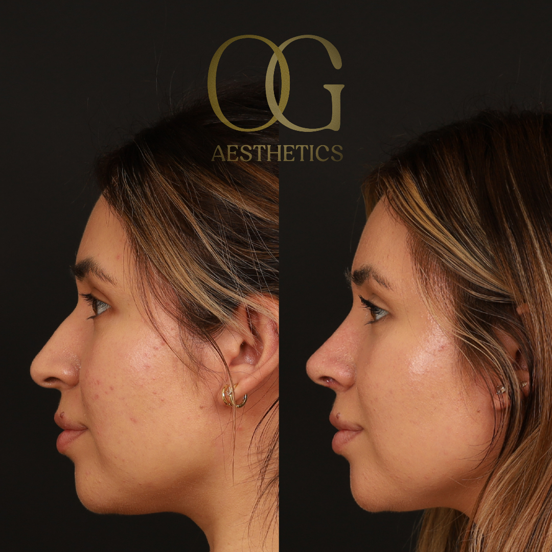 Rhinoplasty Before & After Gallery - Patient 218954 - Image 5