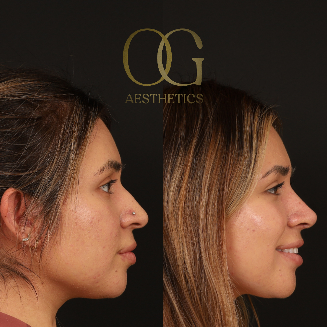 Rhinoplasty Before & After Gallery - Patient 218954 - Image 1