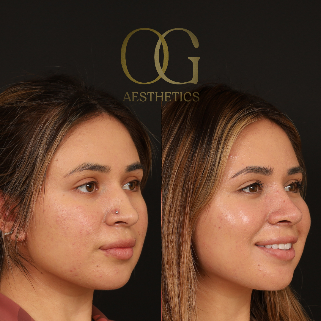 Rhinoplasty Before & After Gallery - Patient 218954 - Image 2