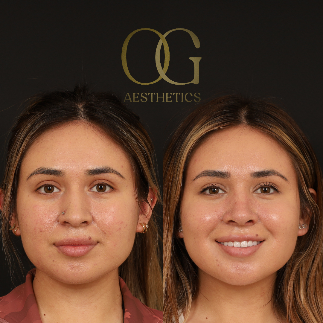 Rhinoplasty Before & After Gallery - Patient 218954 - Image 3