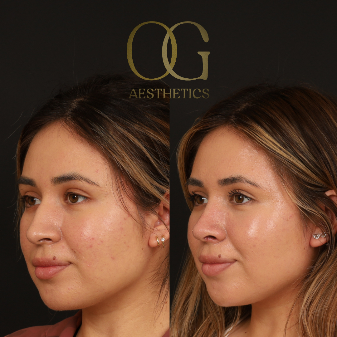 Rhinoplasty Before & After Gallery - Patient 218954 - Image 4