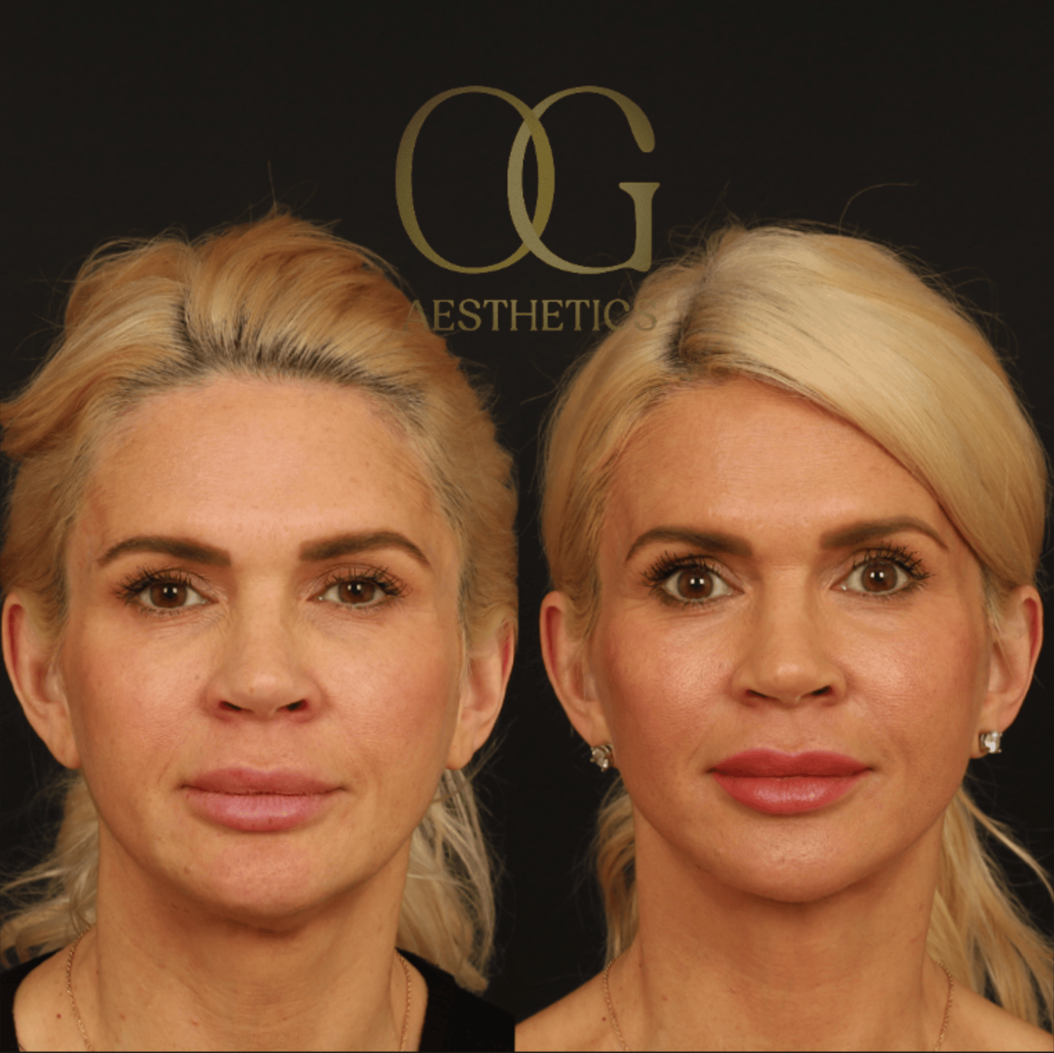 Facelift Before & After Gallery - Patient 253215 - Image 1