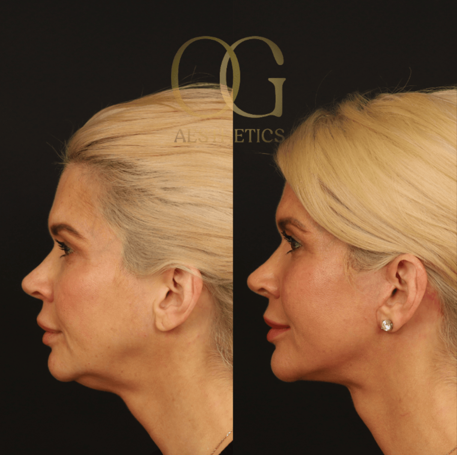 Facelift Before & After Gallery - Patient 253215 - Image 4