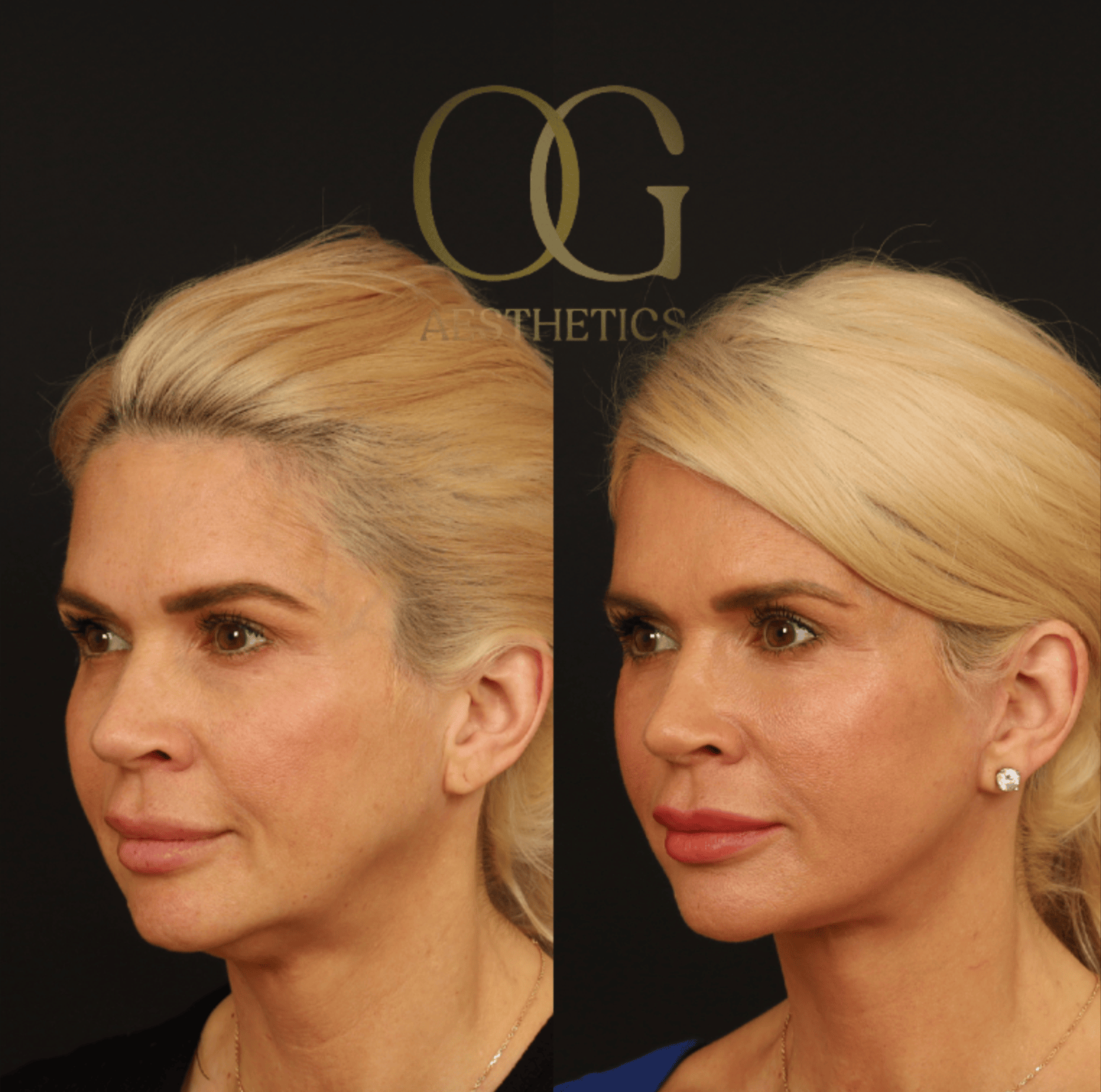 Facelift Before & After Gallery - Patient 253215 - Image 5
